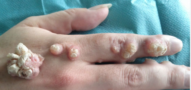 ডুমুর  আঁচিলের  ট্রিটমেন্ট- fig warts treatment