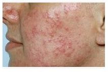 ব্রণ- acne, pimple (ফুসকুড়ি ও দাগ)