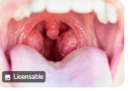 টনসিল বৃদ্ধি (Enlarged Tonsils)