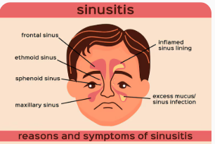সাইনোসাইটিস- sinusitis