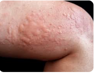 সব ধরনের অ্যালার্জি- -All kind of allergy