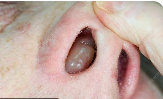 নাকের পলিপাস- nasal poly pus