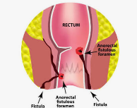মলদ্বারের ফিসচুলা – Fistula in ani