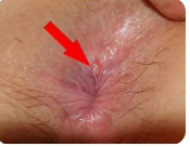 মলদ্বারের ফাটল (Anus Fissures)- হাতের তালু, আঙুলে ফাটল, আঙুলে ফাটল, পায়ে ফাটল।