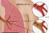 ব্রঙ্কাইটিস-Bronchitis