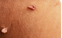 আঁচিল- Warts