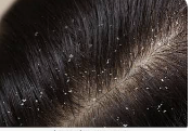 খুশকি - Dandruff