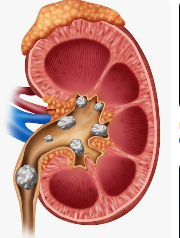 কিডনি বা বৃক্কের পাথর:-- kidney stone
