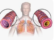 হাঁপানির হোমিওপ্যাথিক ওষুধ -Asthma medicine