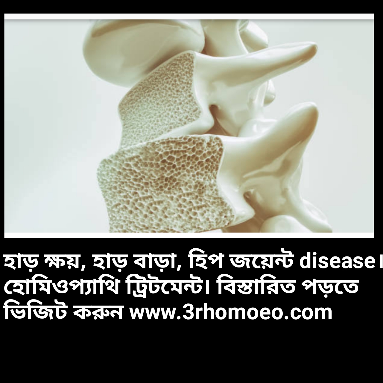 হাড়ের রোগ- Bone disease