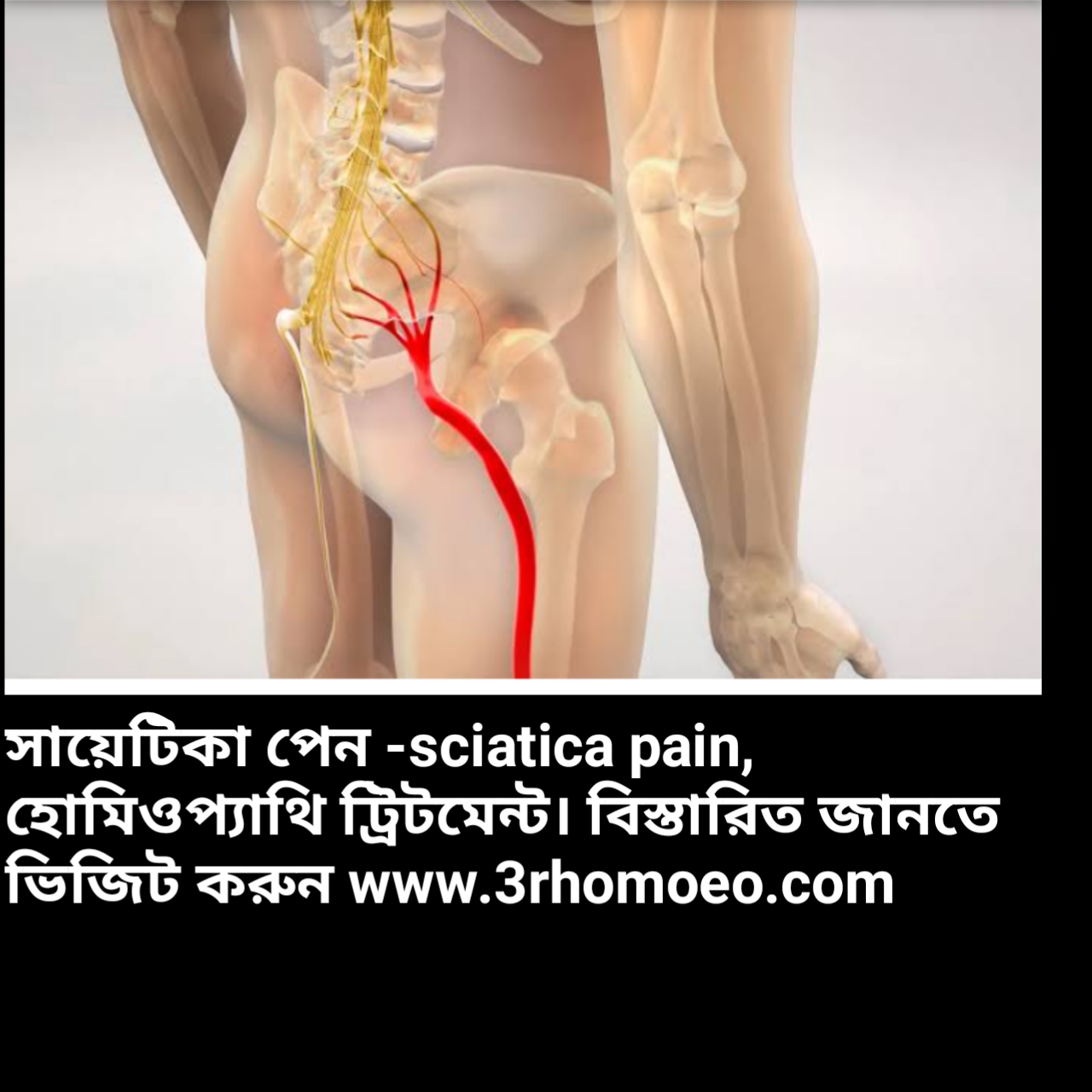 সায়াটিকা-sciatica