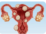 জরায়ুর টিউমার- UTERUS FIBROMA-