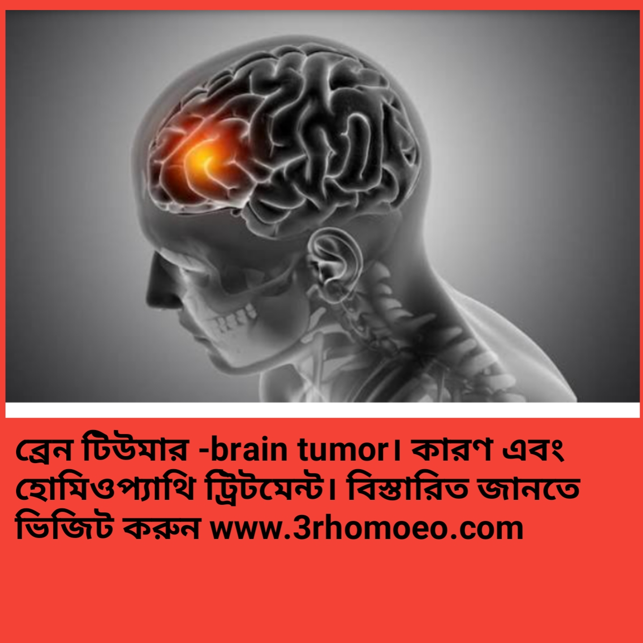 ব্রেইন টিউমার - (গ্লিওমা)