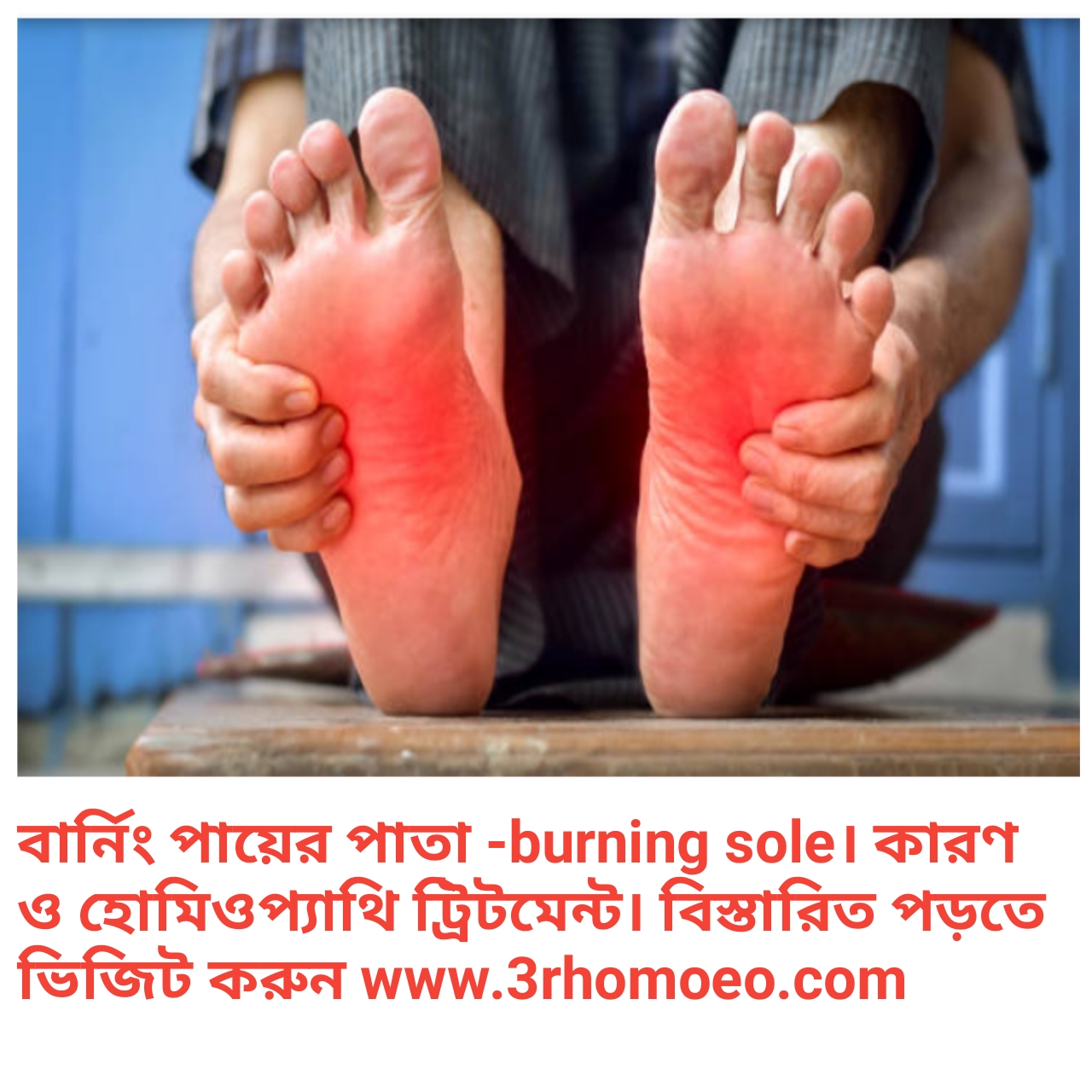 পায়ের পাতা জ্বালা- burning sole of feet