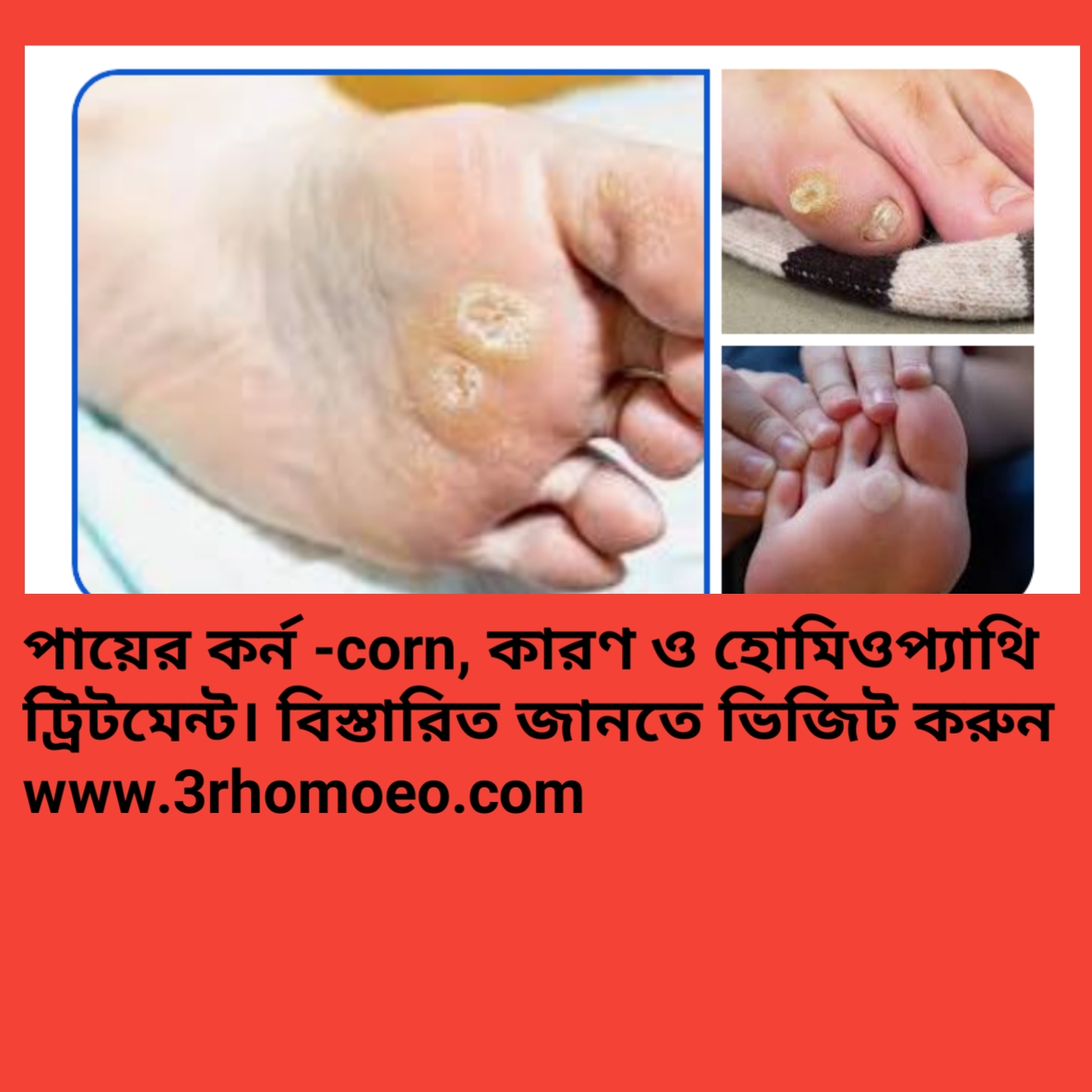 কর্ন (Corns)