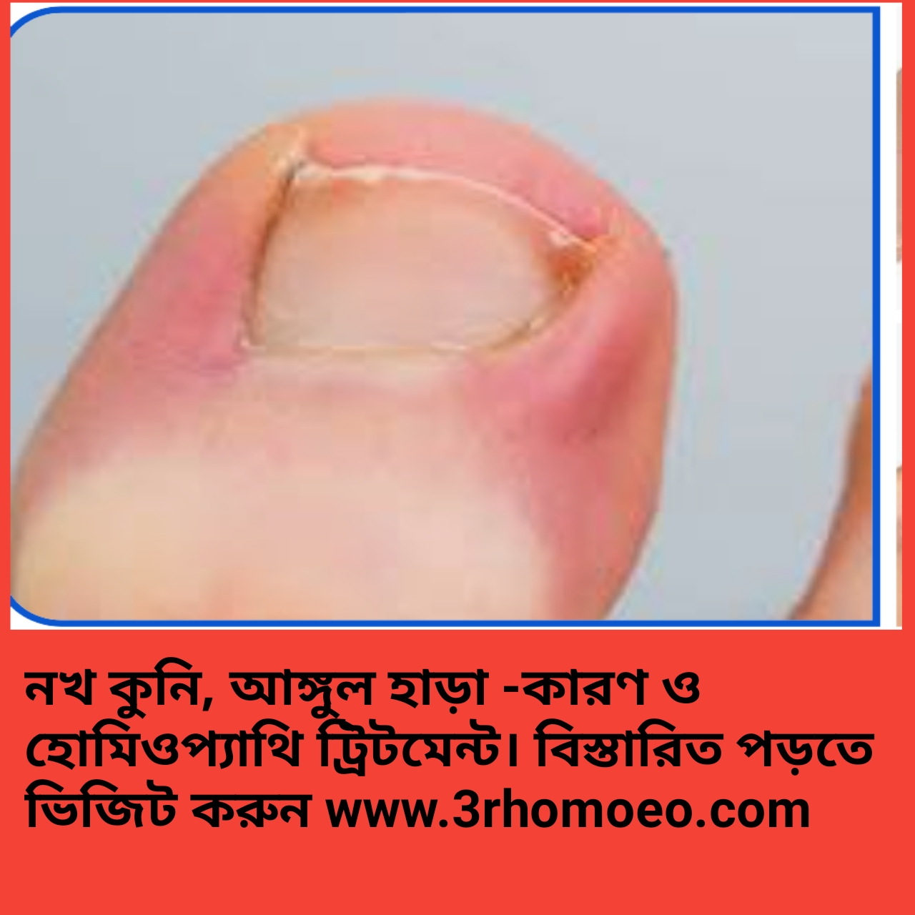 নখকুনি ,আঙ্গুলহাড়া- whitlow