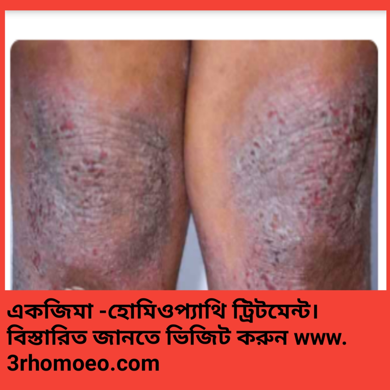 একজিমা-Eczema