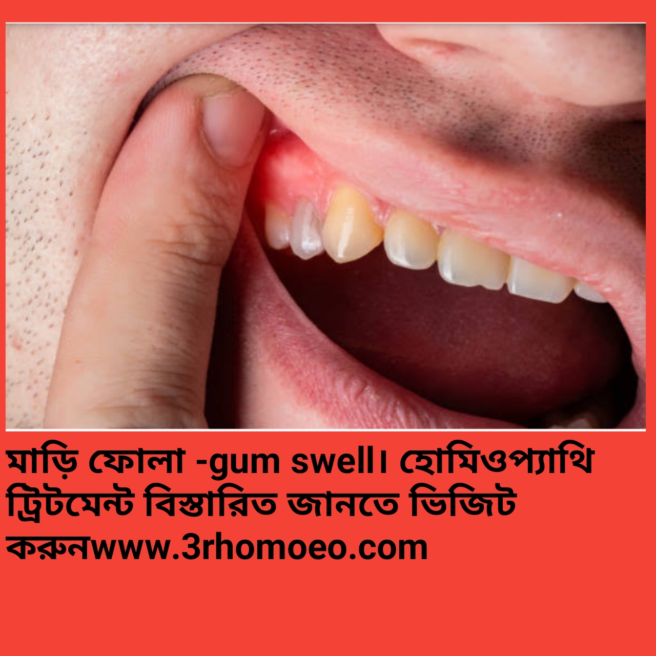 মাড়ি ফুলে যাওয়া—Gum swell