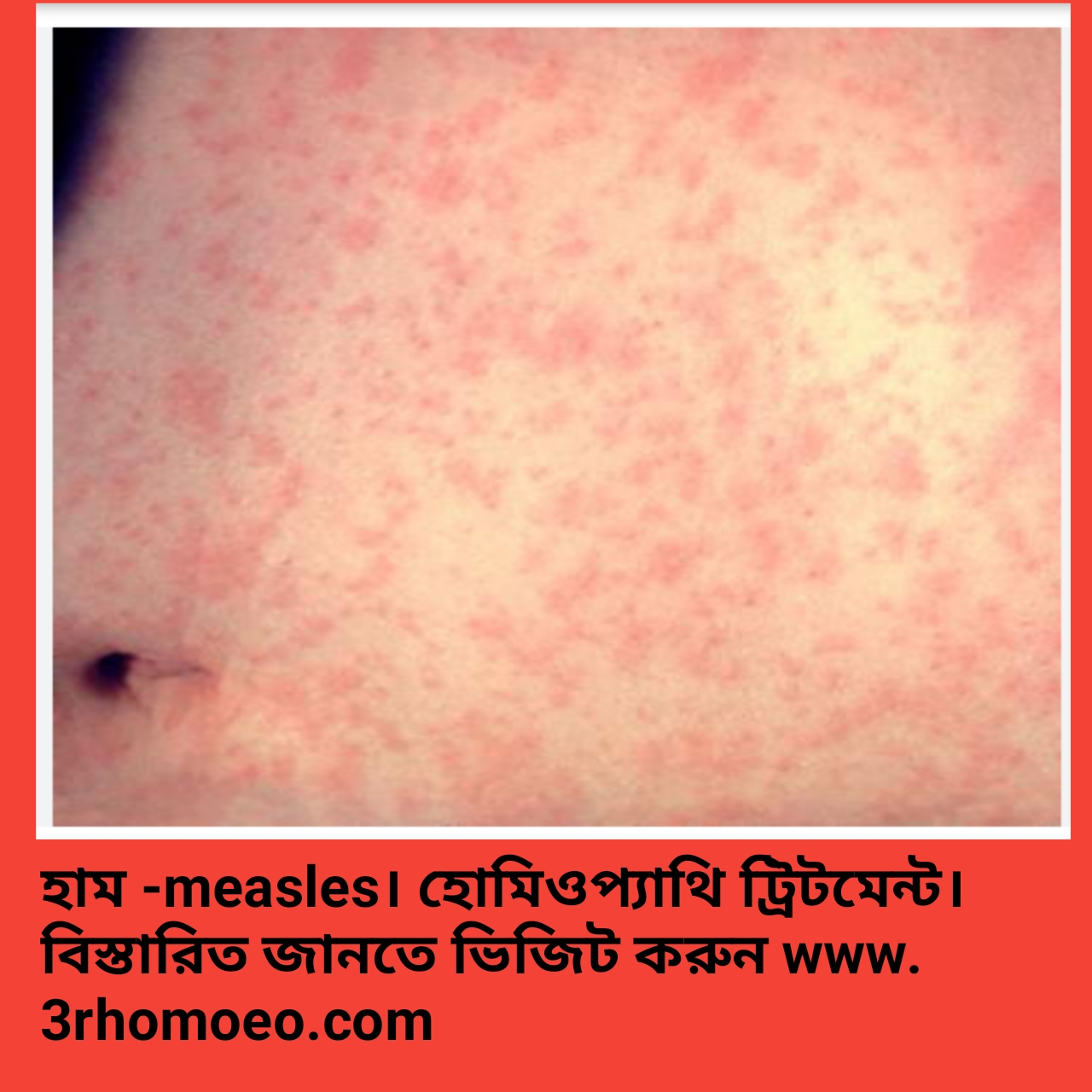 হাম (Measles)
