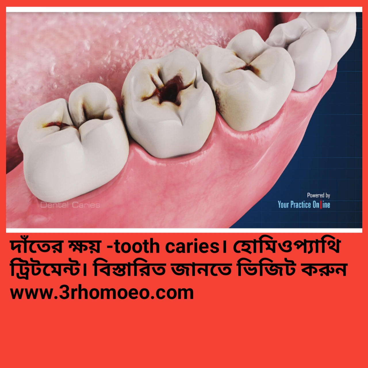 দাঁতের ক্ষয় (ক্যারিজ)