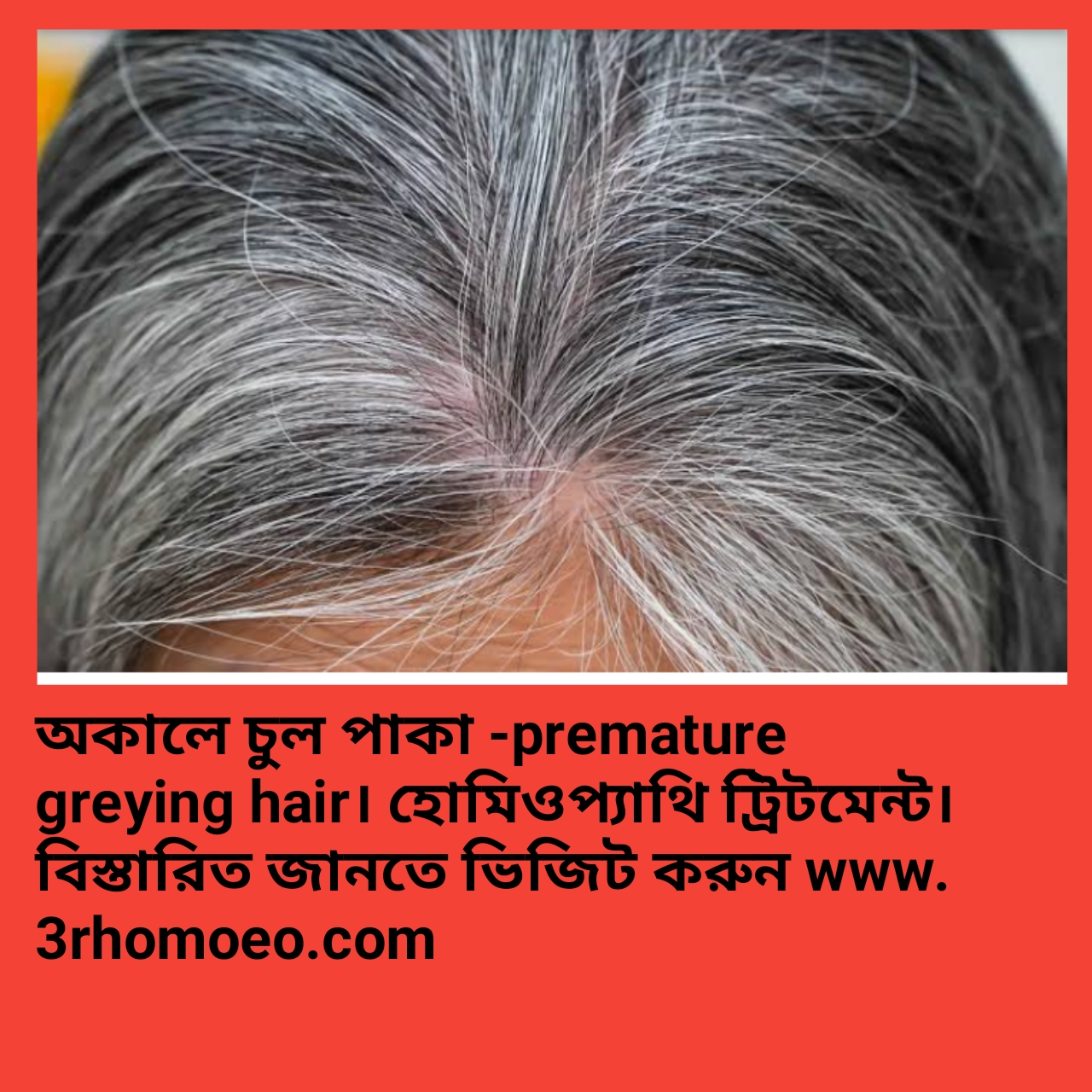 অকালে চুল পেকে যাওয়া-  premature greying hair