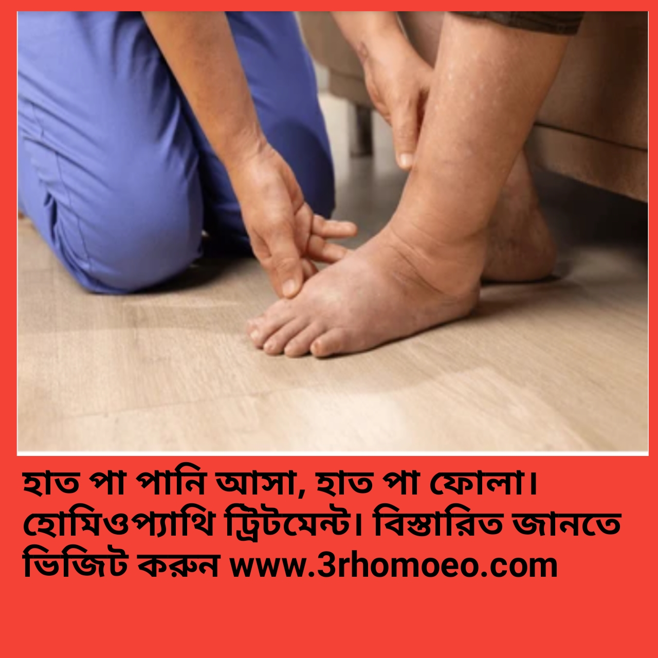 হাতে পায়ে  পানি আসা , হাত পা  ফোলা , অঙ্গ প্রতঙ্গ  ফোলা- edema, swell, ascite
