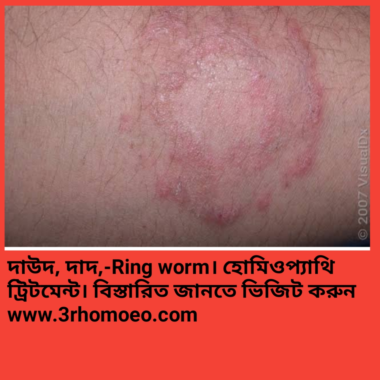দাদ (Ringworm)-