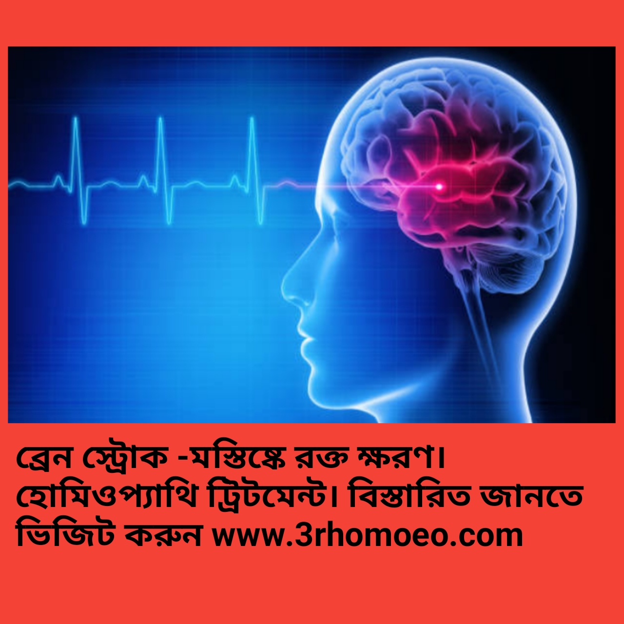 ব্রেইন স্ট্রোক-মস্তিষ্কে রক্তক্ষরণ- brain stroke