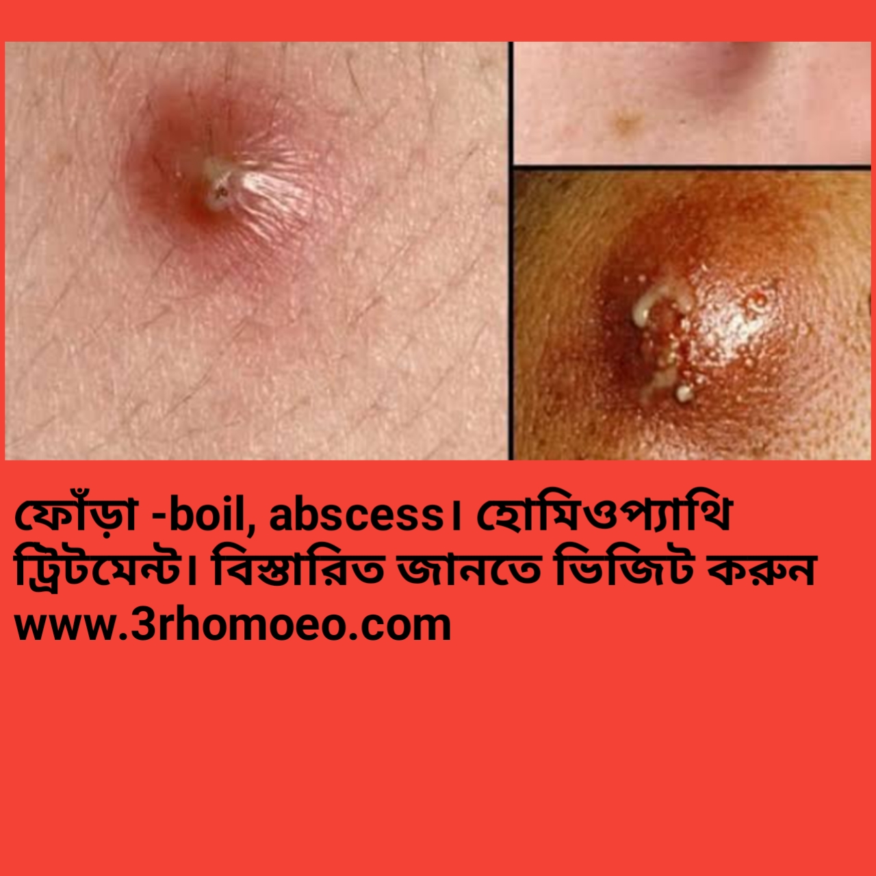 ফোঁড়া বা অ্যাবসেস (Abscess)