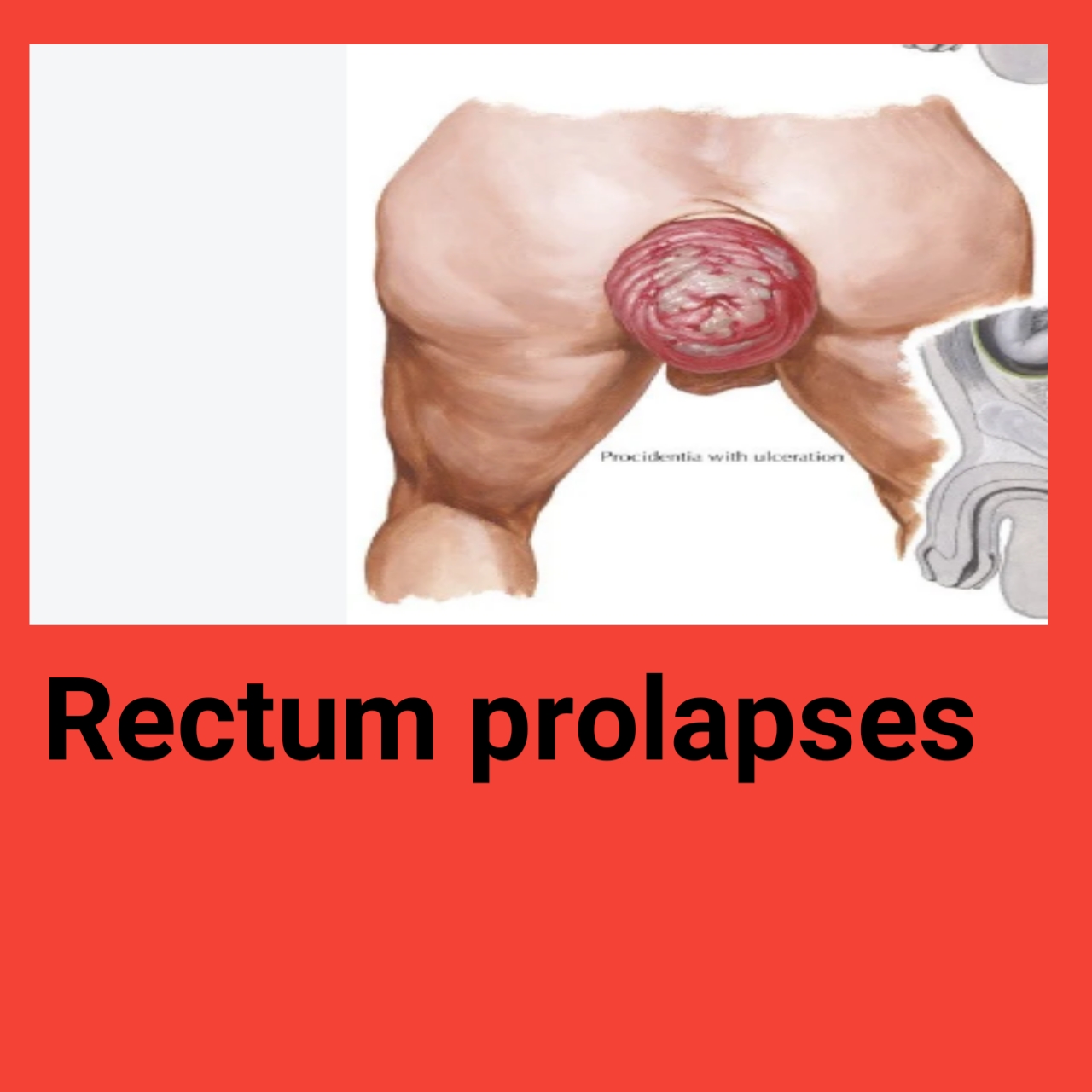 (Rectal Prolapse)