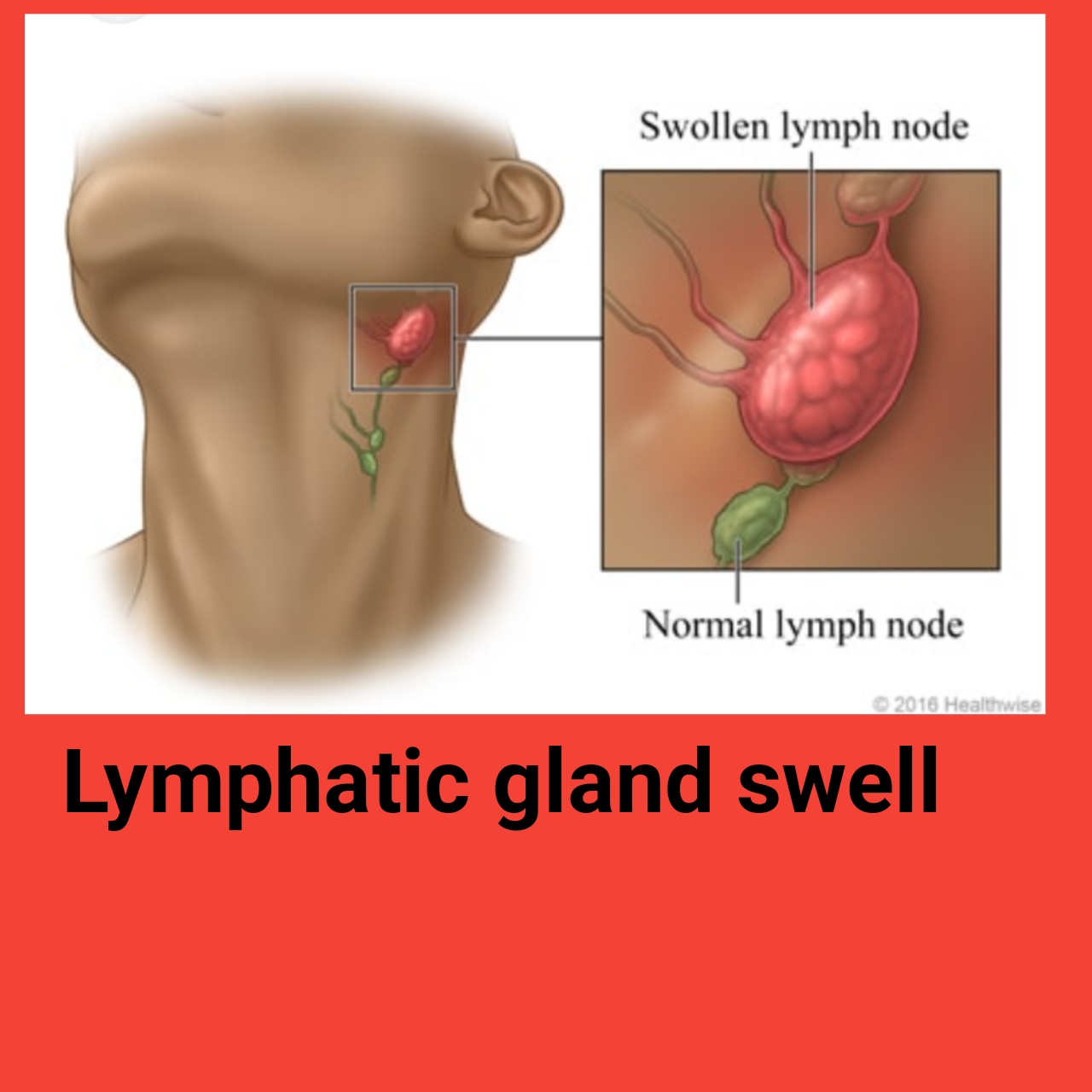 Inflamación de ganglios linfáticos