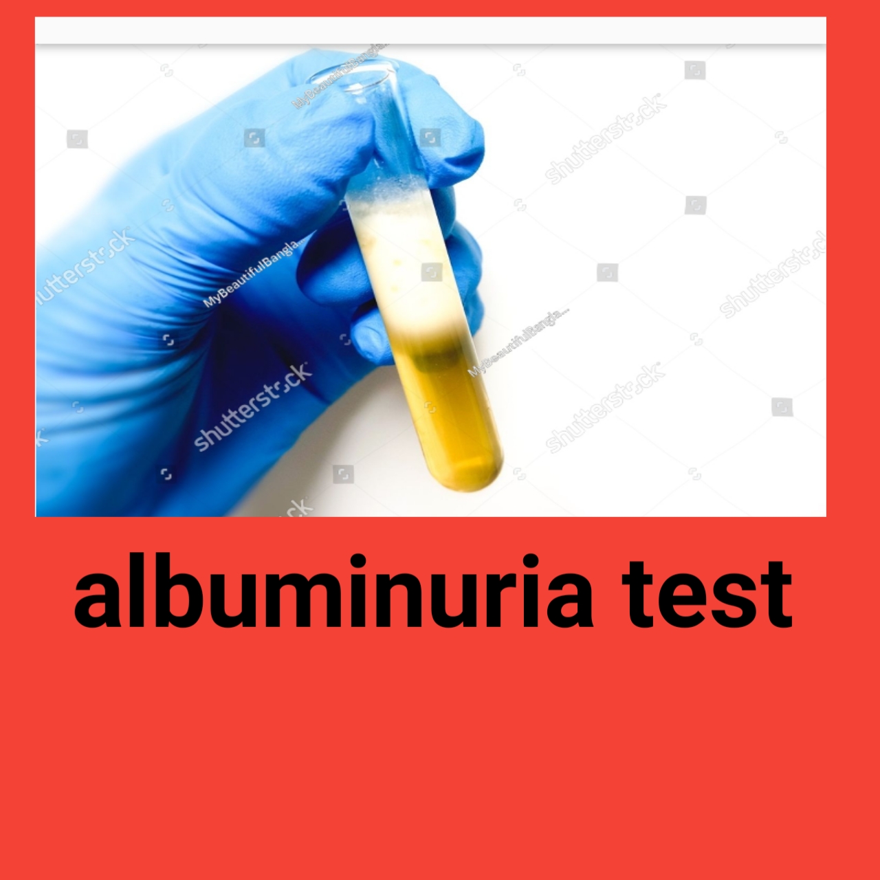 Albuminuria (Proteinuria)