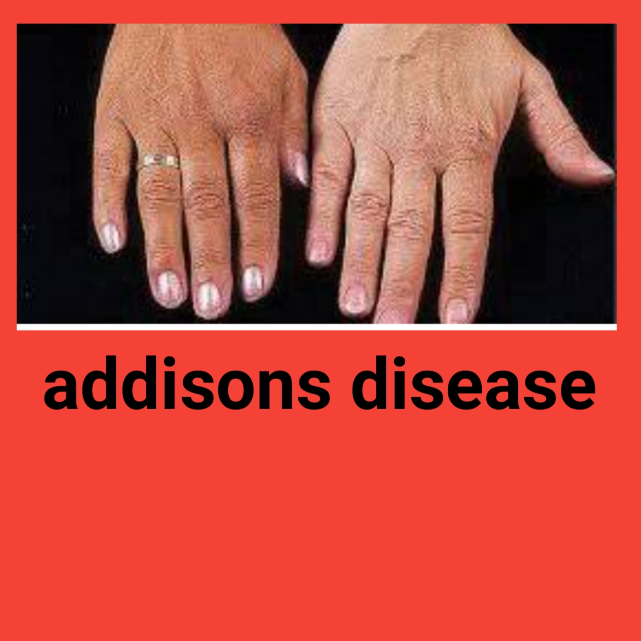 (Enfermedad de Addison)