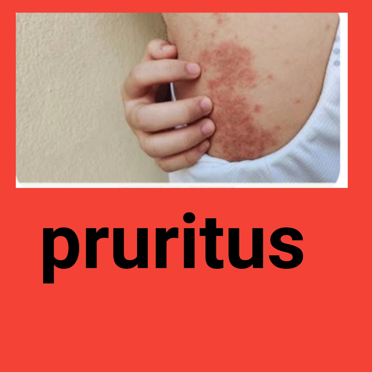 I-PRURITUS