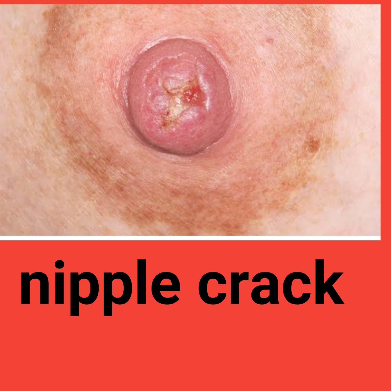 پستان کے مہرے (Nipples):