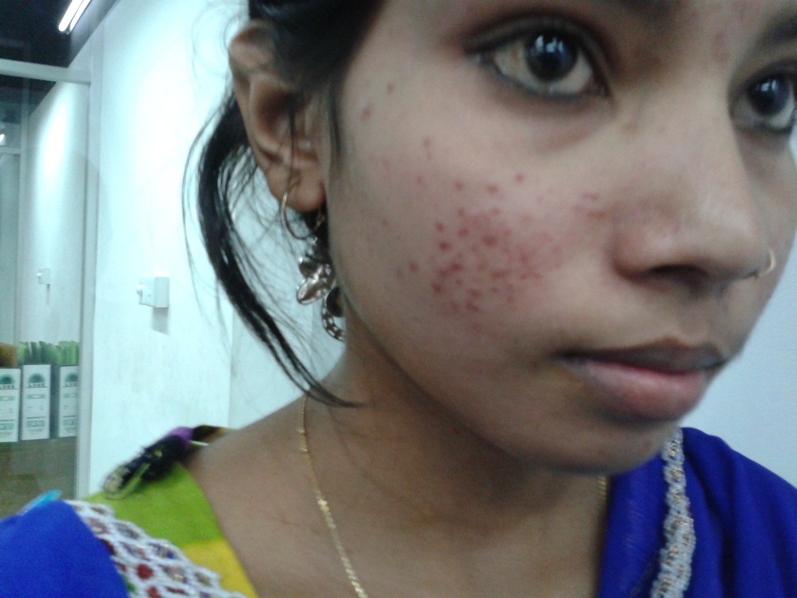 acne before