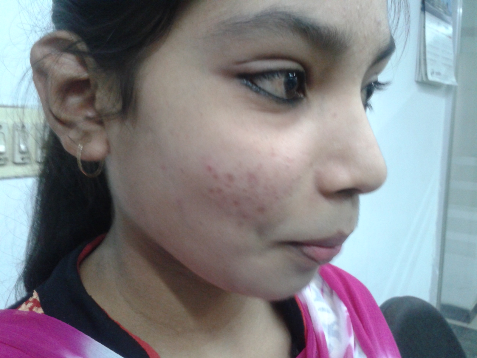 acne after