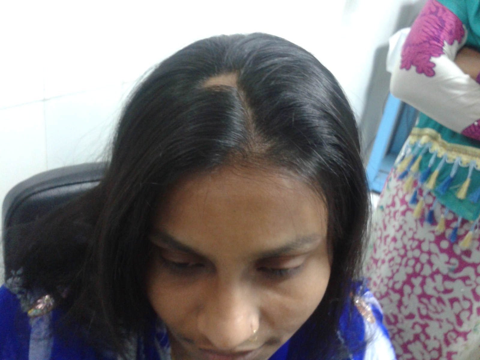 baldness before