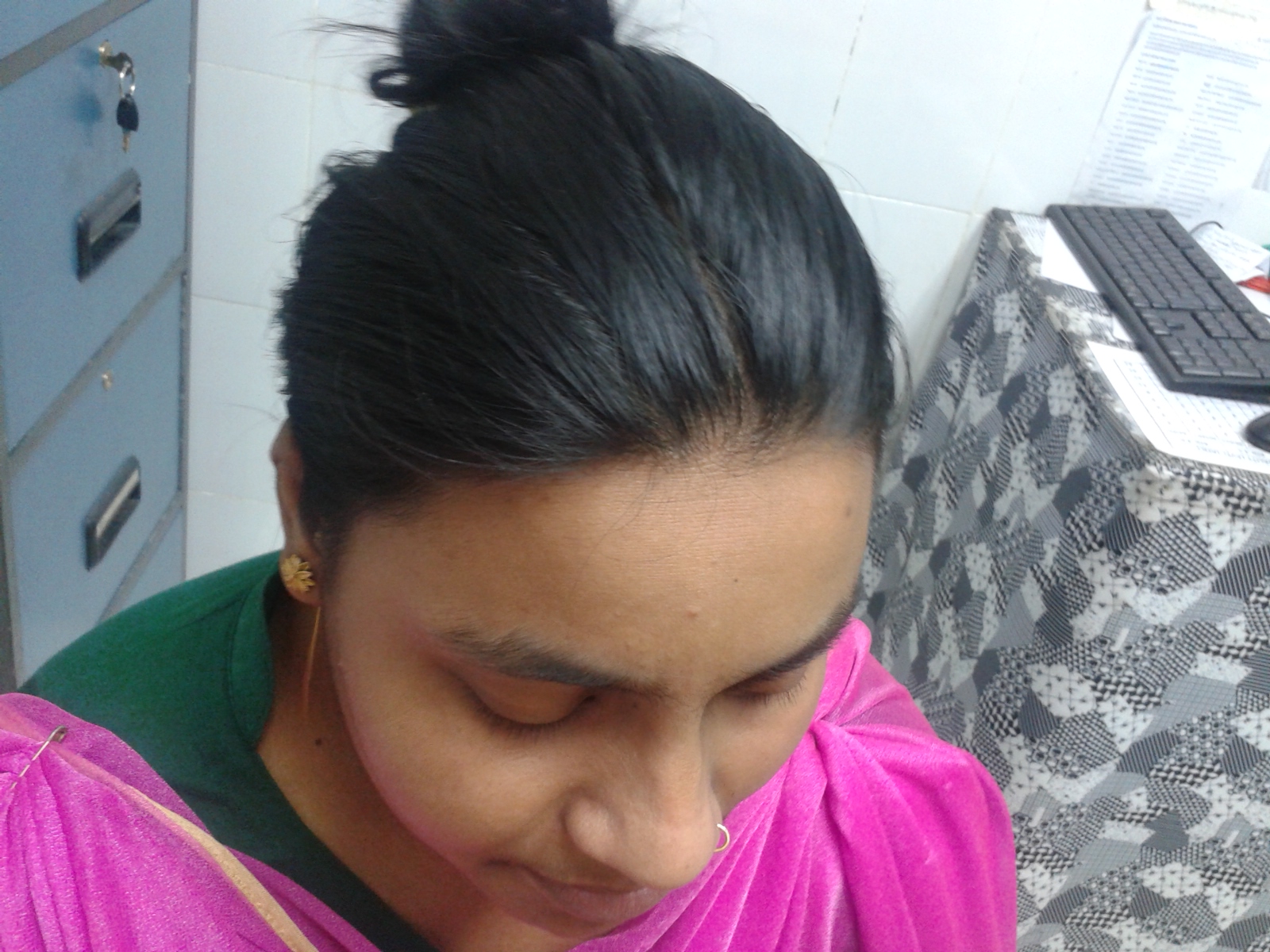 baldness after